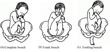 5. A breech birth- this is when a baby is born bottom first instead of head first. Most babies in the breech position are born by CS because it is seen as safer than being born vaginally.