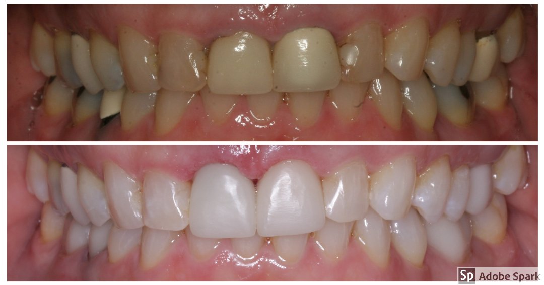 StrobelDentist's tweet photo. We're so grateful for the talent, time, and tech that make helping people transform their smiles possible! #samedaycrowns #strobeldentistry #chicagodentist #smiletransformation #gingevectomy #teethwhitening https://t.co/8dh7oJhhRf