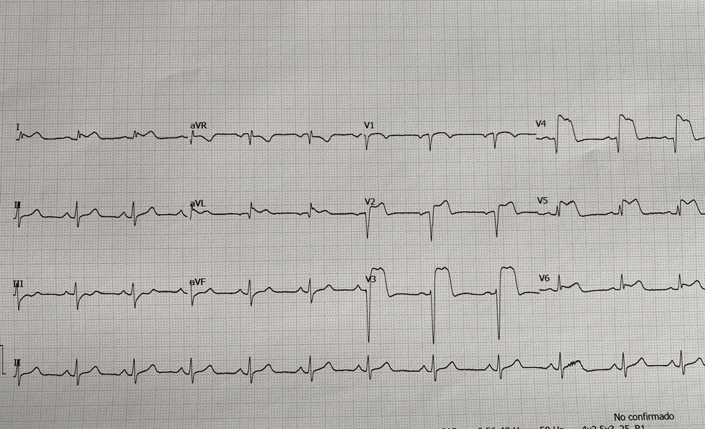 umanamd's tweet photo. In just a few minutes, this patient went from one ECG to the other one.
Glad to have learned this from @amalmattu a few years ago and great for our EM residents to see it in real life!
#ECG #EMcases https://t.co/bwEJt9zwR2