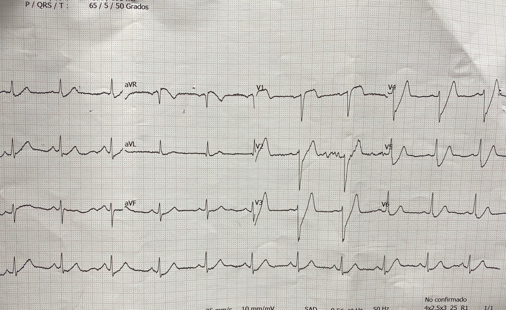 umanamd's tweet photo. In just a few minutes, this patient went from one ECG to the other one.
Glad to have learned this from @amalmattu a few years ago and great for our EM residents to see it in real life!
#ECG #EMcases https://t.co/bwEJt9zwR2