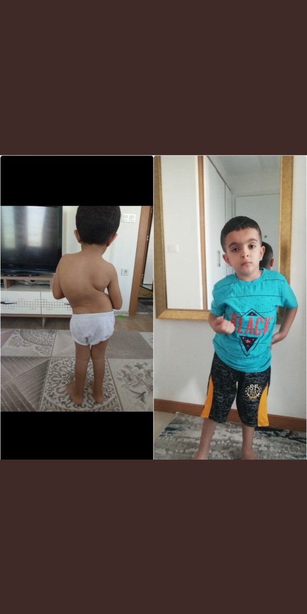 Cihan skolyoz hastası ve ailesinin maddi durumu tedavi etmeye yetmiyor ölüm kapısına gelmeden Allah rızası için ses olun yardımda bulunun 🤲 #cihanasesol