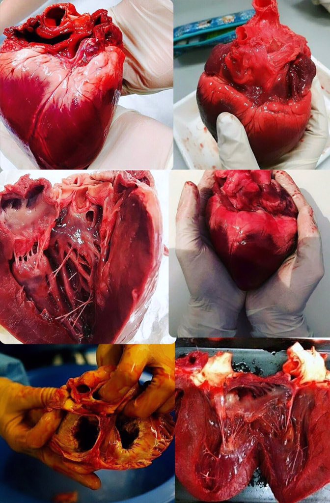 i2p_j's tweet photo. Stages of heart filtration👩🏻‍⚕️💉 https://t.co/xeD9CUVydy