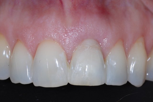 StartSmilingChi's tweet photo. Good afternoon! I’ll be posting an incredible transformation on my Instagram later tonight, but here’s a preview! Replacing a fractured central incisor using a @ZSystemsUSA implant  🙌🏻 IG: StartSmilingChicago &amp; ImplantLive https://t.co/5f1vUug5QH