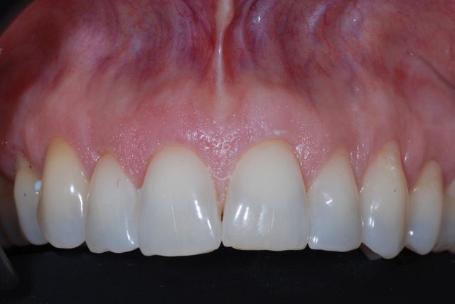StartSmilingChi's tweet photo. Good afternoon! I’ll be posting an incredible transformation on my Instagram later tonight, but here’s a preview! Replacing a fractured central incisor using a @ZSystemsUSA implant  🙌🏻 IG: StartSmilingChicago &amp; ImplantLive https://t.co/5f1vUug5QH