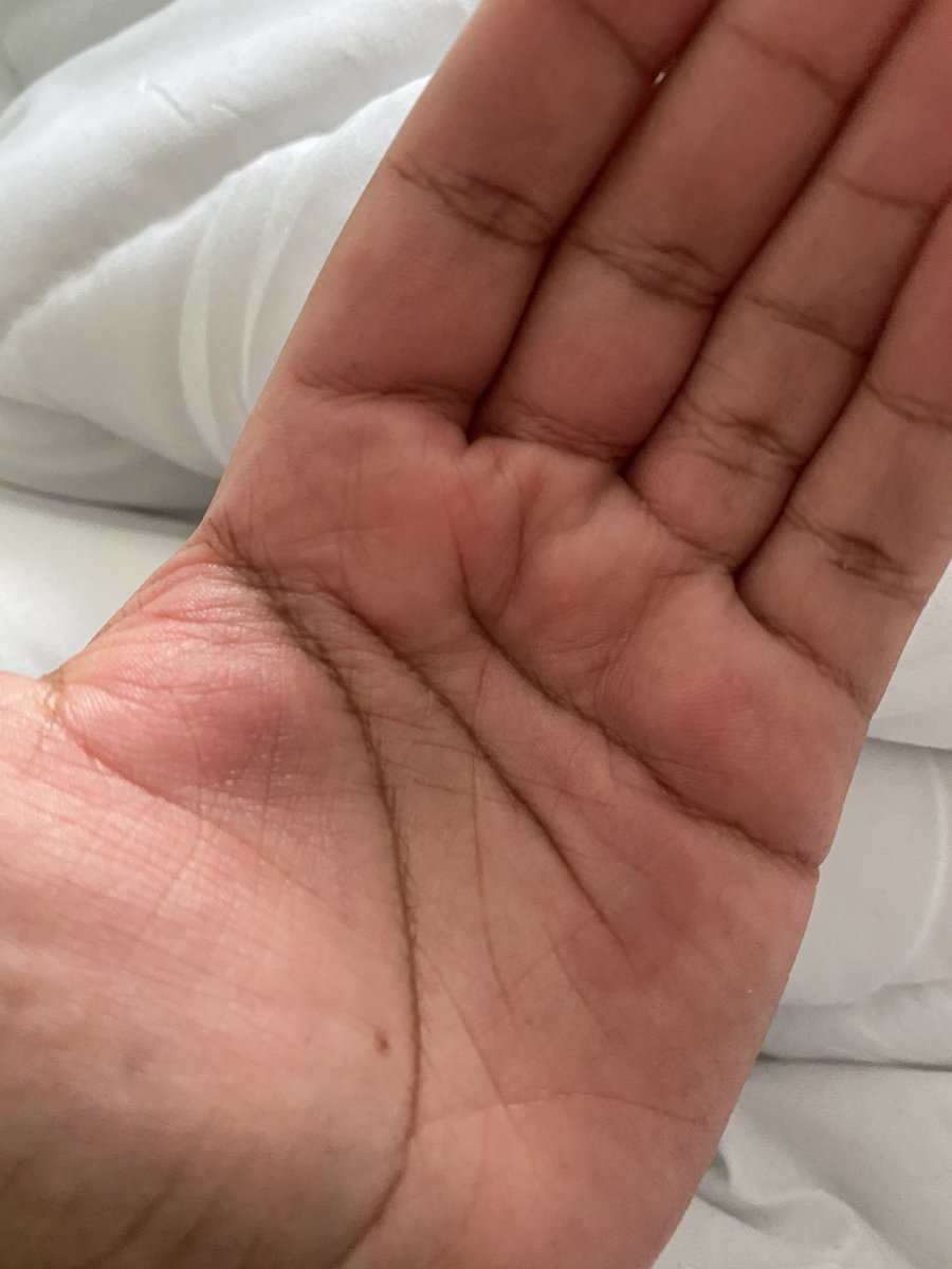 My newest covid symptom—my palms are randomly swelling and it makes it impossible to hold anything or even move them. I literally have to hold ice just for it to be bearable. It kept me up all night. Ugh.