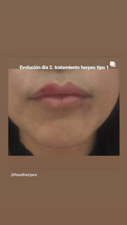 HealHerpes's tweet photo. Evolución paciente herpes #superaelherpes @HealHerpes https://t.co/7efis2xDHr
