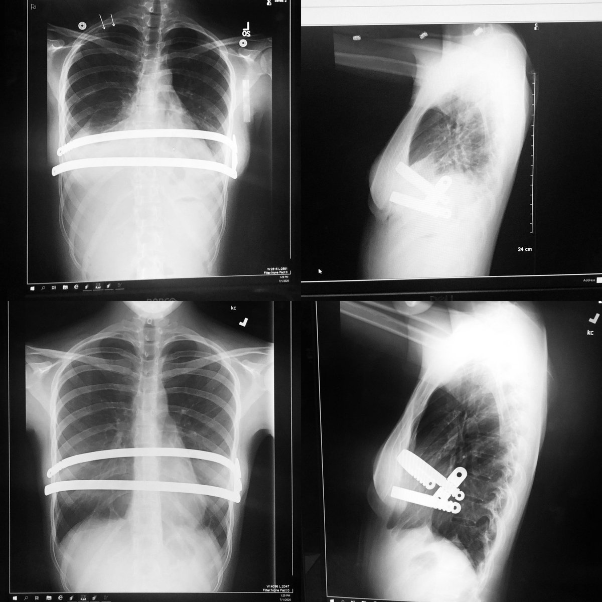 shedavi33's tweet image. Guys! Check out the six week difference in my child’s lungs! God is so good! Top is six weeks ago, bottom is now!!