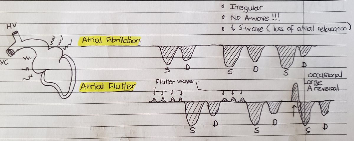 (6/24)Diminished/absent Ar wave- Afib: no Ar wave, w/o atrial relaxation, S wave magnitude  - Liver parenchymal disease ( low compliance thus appears as monophasic aninflectional flow)- Aflutter: f-waves, if flutter wave occurs with TV closurebig Ar wave!