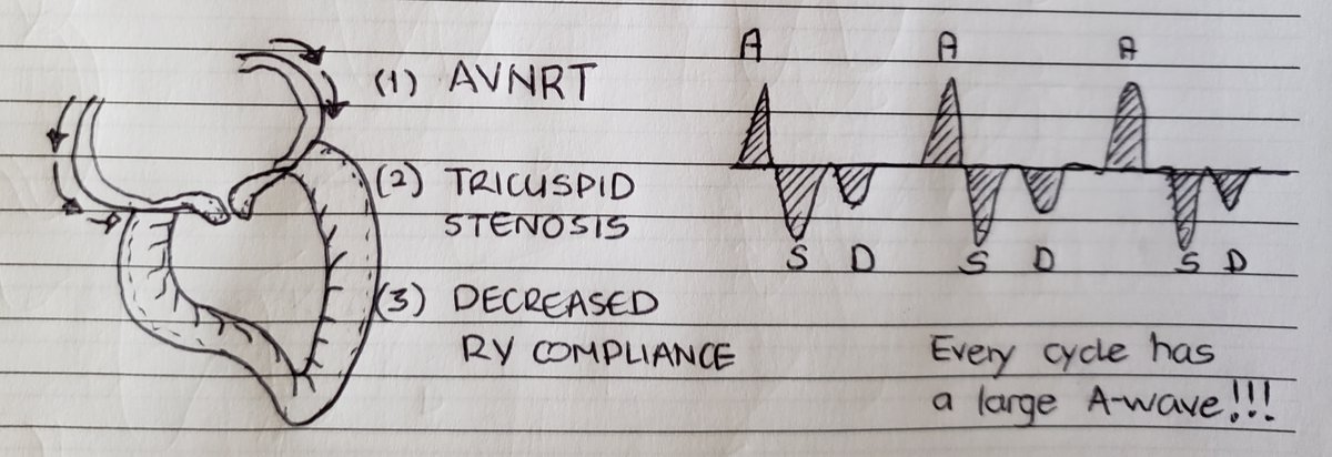 (7/24) Prominent Ar wave all the time: think fixed obstruction! or conduction abnormality that leads to atrial contraction against a closed TV all the time.