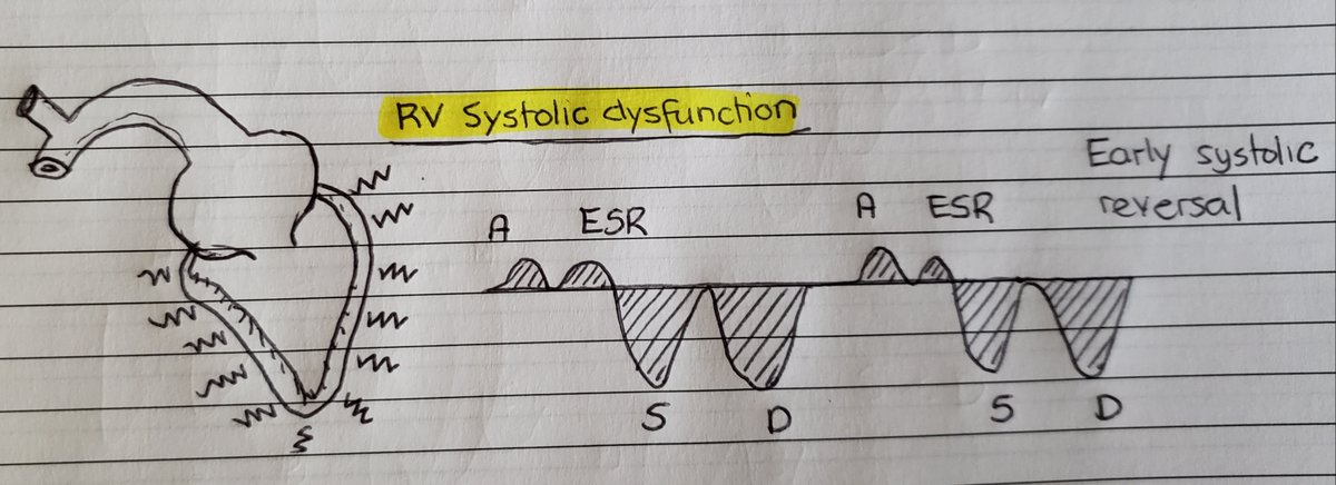 (14/24) In pts with RV systolic dysfunction, this is manifested as an early systolic flow reversal (ESR) with a late small S-wave. Its early because lack of downward RV movement.
