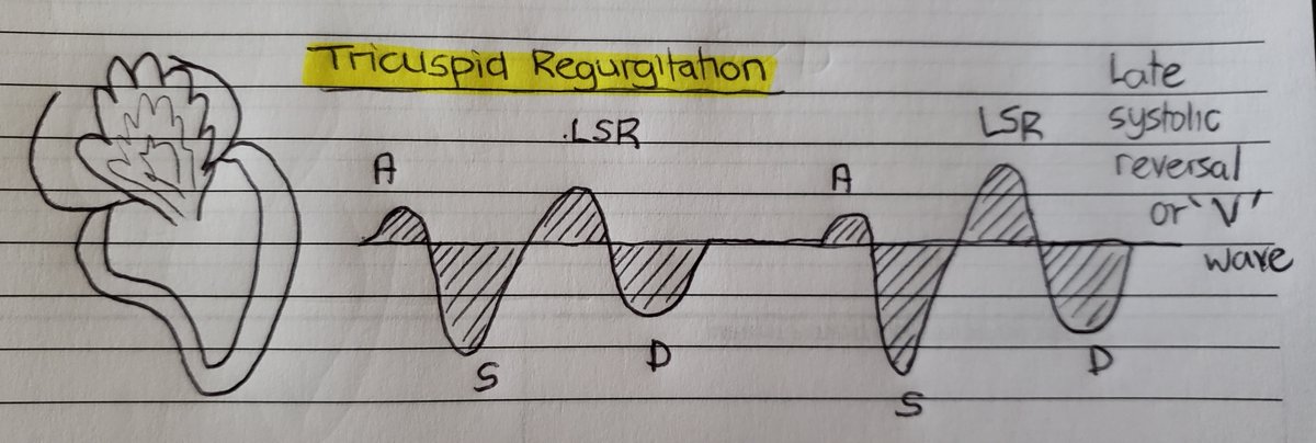 (15/24) However in TR, as systole progresses more volume builds up in the RA and therefore flow reversal is expected to be late! Known as S-reversal wave or V-wave.