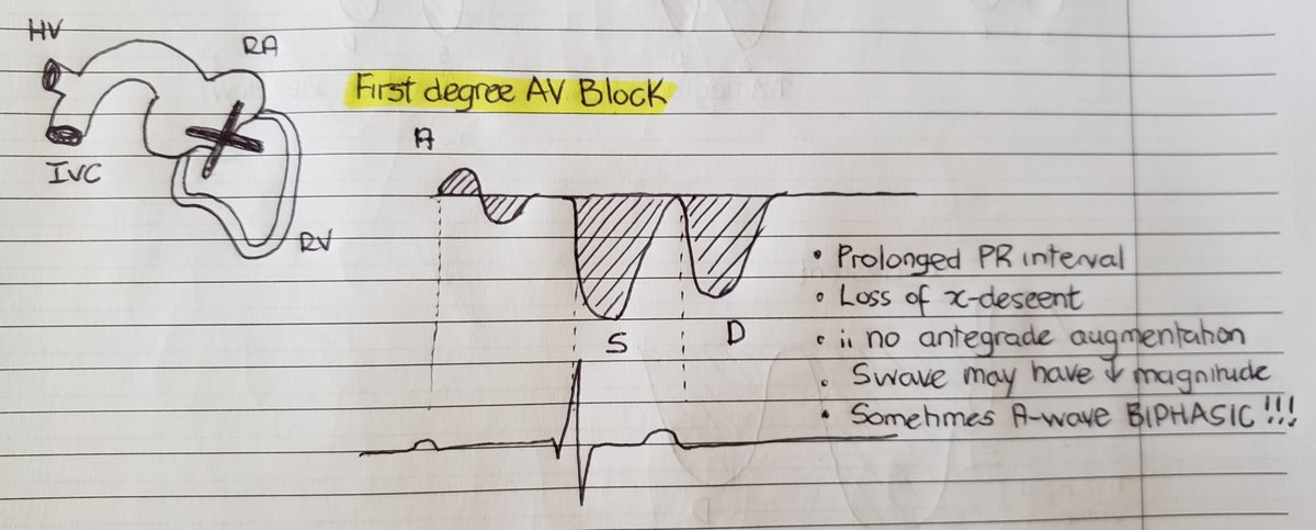 (9/24)Biphasic Ar wave: this is a rarity but can be seen. due to prolonged PR interval. The Ar wave may become biphasic. Another downstream effect is loss of x descent which translates to smaller S-waves.