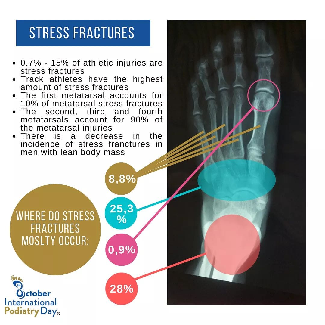 CenturionPod's tweet photo. #podiatrist #footpain #DefeatFootDisease #FIPIFP #stressfractures #sport #myfeetarekillingme #internationalpodiatryday https://t.co/ApdmvdEN0D