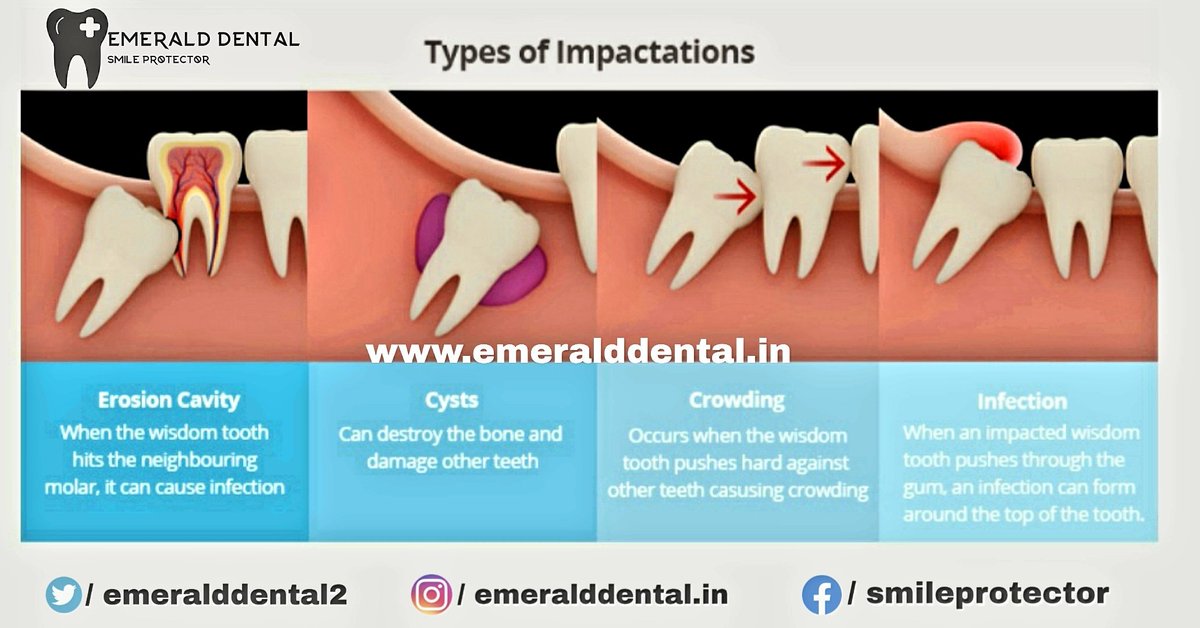 Emeralddental2's tweet photo. Why Should I Have My Wisdom Teeth Removed?
https://t.co/kz3KsCGSpl
#EmeraldDental #wisdomteeth
#dentalhealth #cavity
#safetyfirstalways #Covid19India
#Doctors #Medical #Smile #Perodontics #Orthodontics #DentalAnatomy #family #Pedodontics #Prosthodontic #oralPathology #oralcare https://t.co/5Fh0FrrbT7