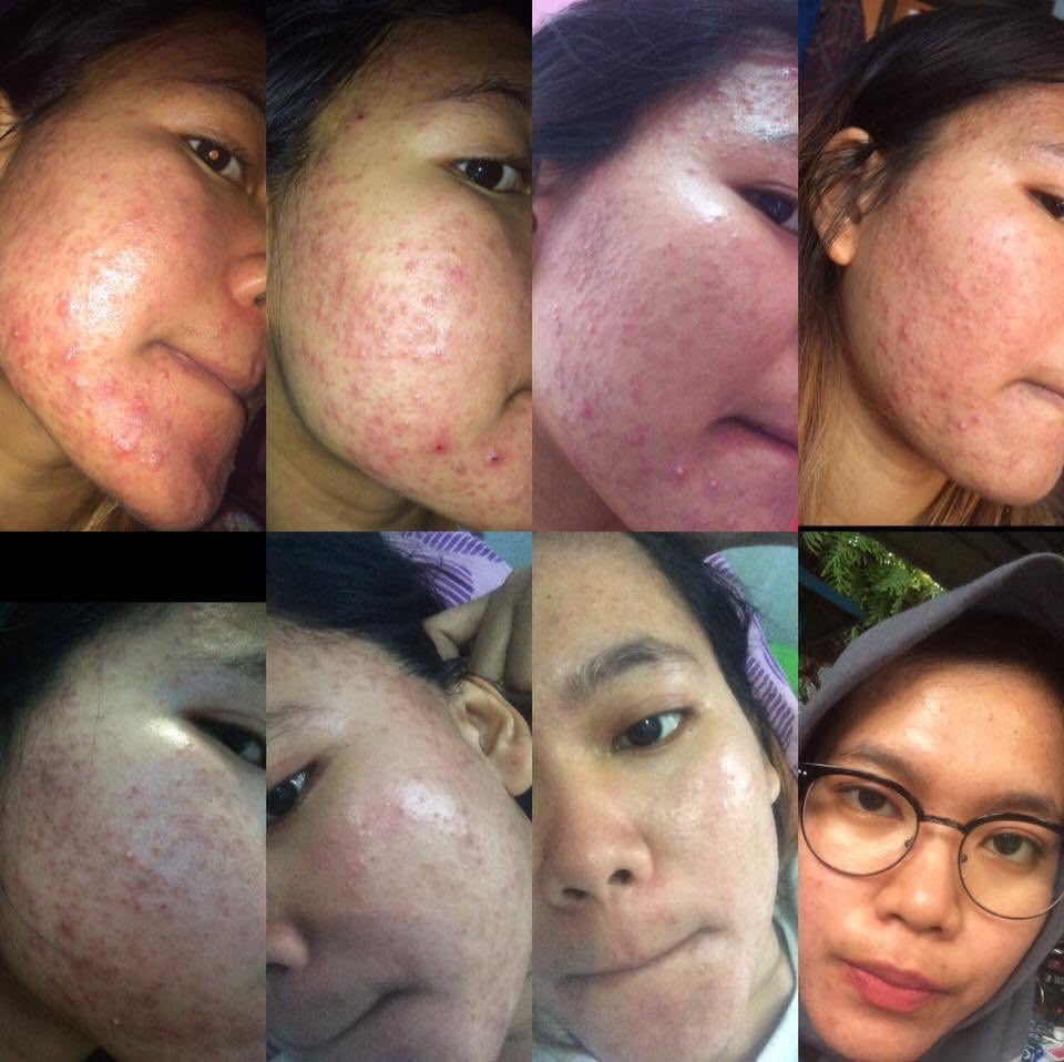vinabinanjay's tweet photo. Mau bikin thread, ya curhat aja sih siapa tau bisa buat pertimbangan kalian 
siapa tau malah ada yg punya pengalaman sama kaya aku  “Muka ancur gara2 skincare tanpa ada dr.spKK ( NavaaGreen, Ella skincare, Natasha ) “ bodoamat sebut merk jelas https://t.co/pBjV5EKst3