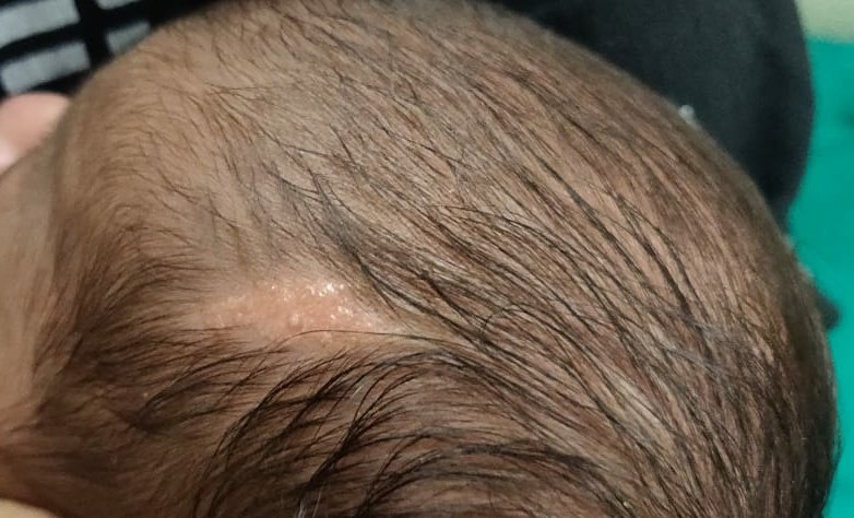 BHUSHAN MADKE MD On Twitter Hairless Yellowish Plaque On Scalp Nevus 