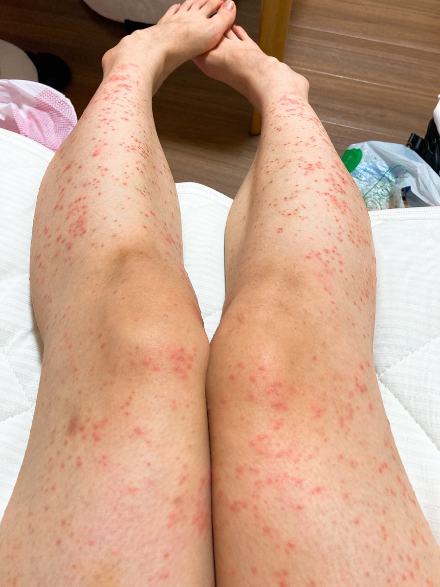 つ ありがとう めちゃくちゃ痒いんやけど 湿疹の出方的にアレルギーじゃないらしい 免疫異常かストレスかなぁ ゚ ゚ W ゚ ゚ とりあえずステロイドと抗ヒス飲んでる 代の女子にわりとありがちらしいから おゆうも気をつけてー つ ありがとう めちゃくちゃ痒いんやけど 湿疹の出方的にアレルギーじゃないらしい 免疫異常かストレスかなぁ ゚ ゚ W ゚ ゚ とりあえずステロイドと抗ヒス飲んでる 代の女子にわりとありがちらしいから おゆうも気をつけてー