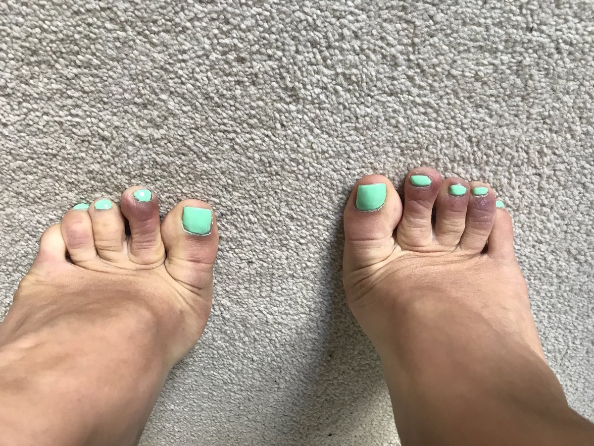 Jordan24255152's tweet photo. Update: Two months on and the pain is gone but the discolouration is still present - it is more noticeable when putting weight on my feet (as per this image). Have not had an antibody test. How is everyone else’s doing? https://t.co/5bzeXRogkb