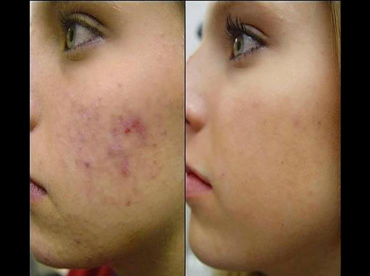 riham_khazrajee's tweet photo. مجموعة علاج حب الشباب الامريكيه مرخص من وزارةالصحة الامريكيه و ال FDA، بدون أي آثار جانبيه لأن المكون للمنتج هو طبيعي 100 % 
منتج روووعه و النتيجه اكيده و يبين التحسن خلال اسبوع👌وخلال شهر فرق واضح 
مو بس يعالج حب الشباب و إنما حتى يخلص من آثار حب الشباب
 التواصل خاص
#السعودية https://t.co/mXIr3sERuh