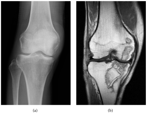 Imagen: Dos radiografías que comparan un hueso normal con un hueso con osteonecrosis.