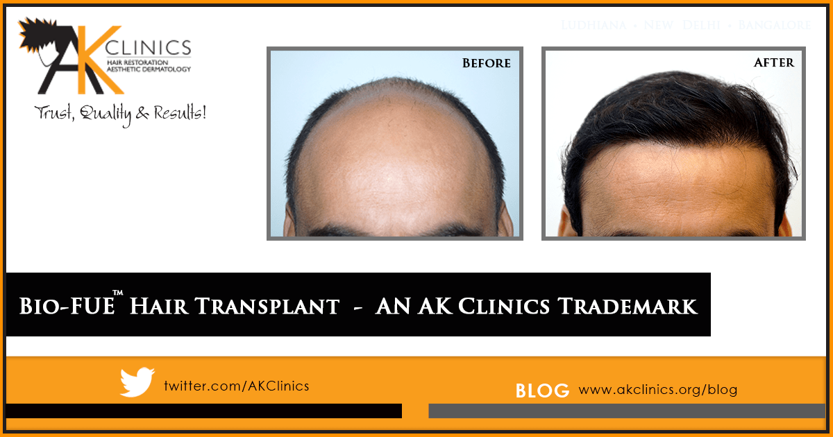 AKClinics's tweet photo. Bio-FUE Hair Transplant - An AK Clinics trademark procedure of FUE hair transplant developed by our own team of doctors at AK Clinics. It is a long term customized plan of hair restoration for our patients, know more @ https://t.co/S8b8lu950Y
#HairTransplant #BioFue #HairLoss https://t.co/NWyX74nf7k