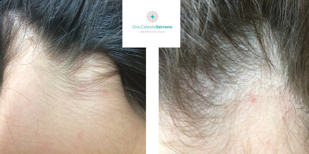 CSerranoV's tweet photo. Pápulas pruriginosas en la parte posterior del cuello cercano a la línea de implantación de piel cabelluda. Qué sospechan ? #dermaquiz #dermachallenge #dermatologia #derma #dermatology https://t.co/DnpmFgQxJ6