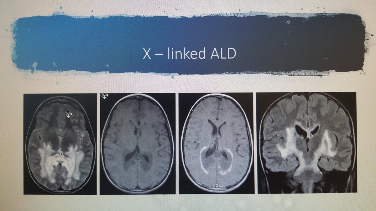 griz1's tweet photo. Adrenoleukodystrophy summary of features &amp; radiographic appearance. @uclapedsneuro Noon Conf #PNNC by #DrGShrestha. @UCLAMCH @PedNeurBriefs @CNS_Connect @Child_Neurology @meeryo @KidsBrainsDrO @Drjonsantoro @TheASNR @AANMember @RareDiseases #WhiteMatterMatters #GizaPedNeuro https://t.co/tOBuBnPxpe