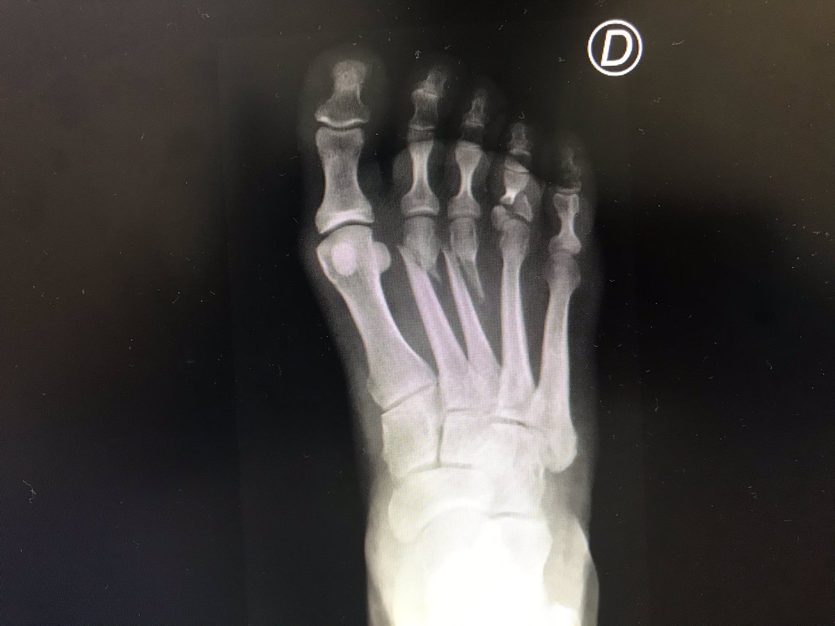 RX_SALUD's tweet photo. #Paciente que viene de #Traumatología , porque se ha caído limpiando...vaya tela!! 

Feliz Martes!! ☢️

#RadiologiaSalud #Radspain #Radiology #Radiologi #xrayschool #xraystudent #Xray #Radiologist #Rayosx #Sanidad #Salud #Medicina #Radiología #Tsid #Radiographers #covid19 https://t.co/kE7a7bpoap