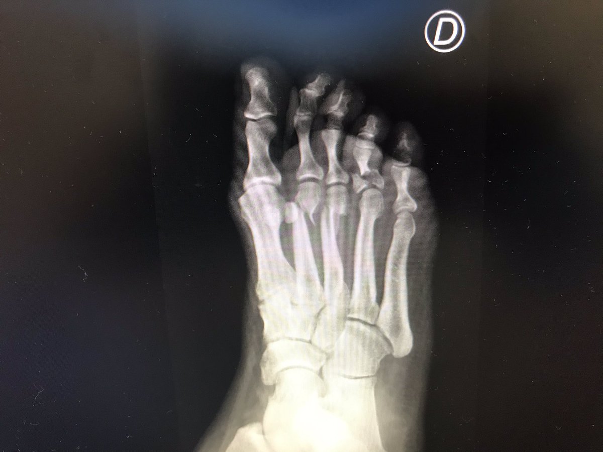 RX_SALUD's tweet photo. #Paciente que viene de #Traumatología , porque se ha caído limpiando...vaya tela!! 

Feliz Martes!! ☢️

#RadiologiaSalud #Radspain #Radiology #Radiologi #xrayschool #xraystudent #Xray #Radiologist #Rayosx #Sanidad #Salud #Medicina #Radiología #Tsid #Radiographers #covid19 https://t.co/kE7a7bpoap