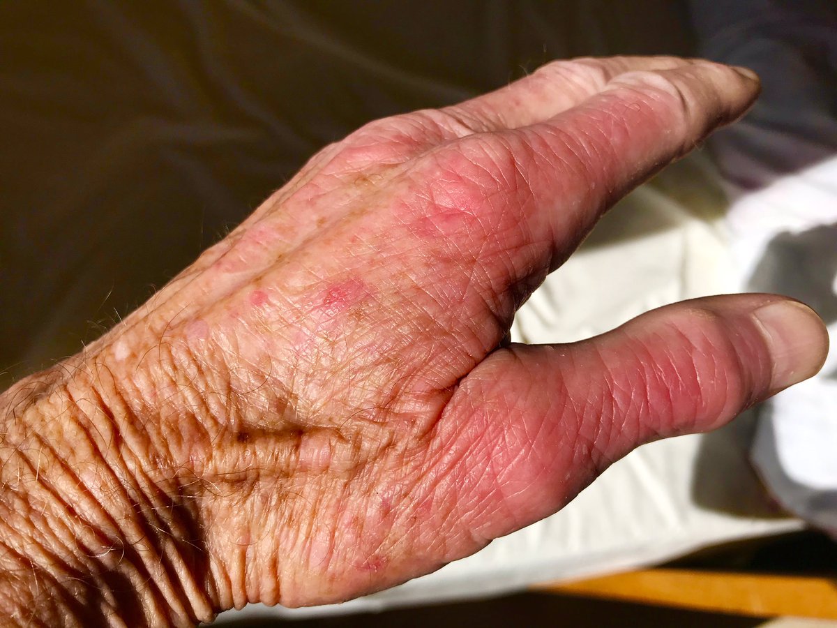 Michael4Art's tweet photo. @WeAreSRUK can you advice on this sudden attack with burning sensation with extra sensitivity to sunlight and water. Any treatment please https://t.co/im8iHUwhGe