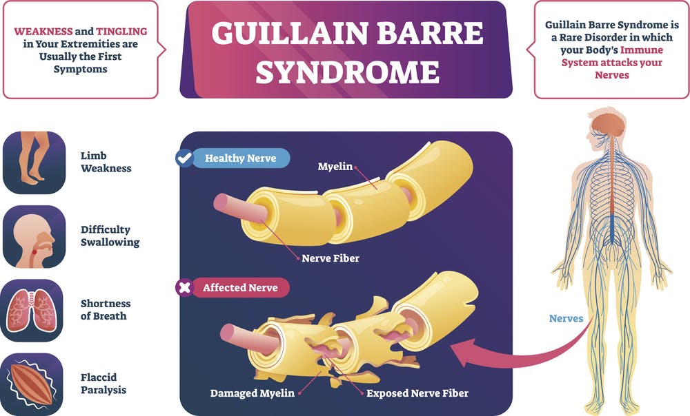 MountSinaiNeuro's tweet image. #NeuroCC neurologist, @drdangayach, discusses the rare neurological disorder, Guillain-Barre Syndrome, and how it&apos;s linked to #COVID19. @neurocritical @aartisarwal @PittTweet #GBS #autoimmune

theconversation.com/rare-neurologi… via @ConversationUS
