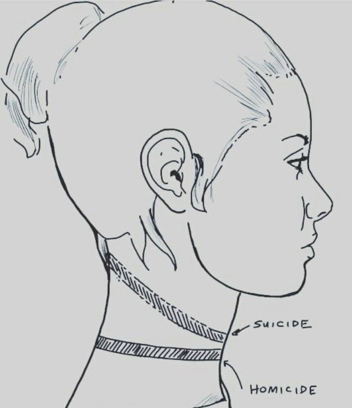 Ligature Strangulation