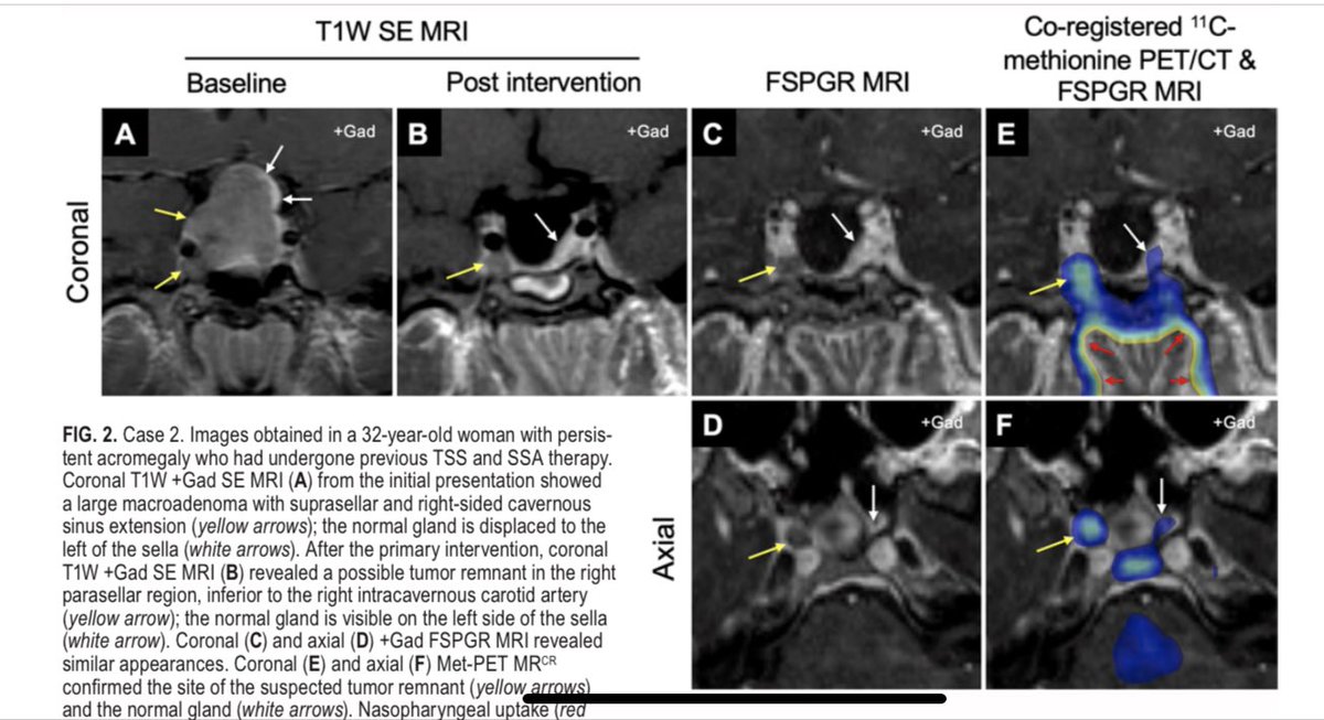 NeuroendocrinoS's tweet photo. Cirugía transesfenoidal guiada PET/TC +11 C-metionina en 
#Acromegalia persistente por enfermedad selar/parasellar lateral
✔️9 pacientes 
✔️Excluido Knosp 4
✔️Puede ser útil evaluación enfermedad selar/parasellar lateral y para cirugía dirigida 
@TheJNS 
https://t.co/cBMWzjbKib https://t.co/dCQClTlvj0