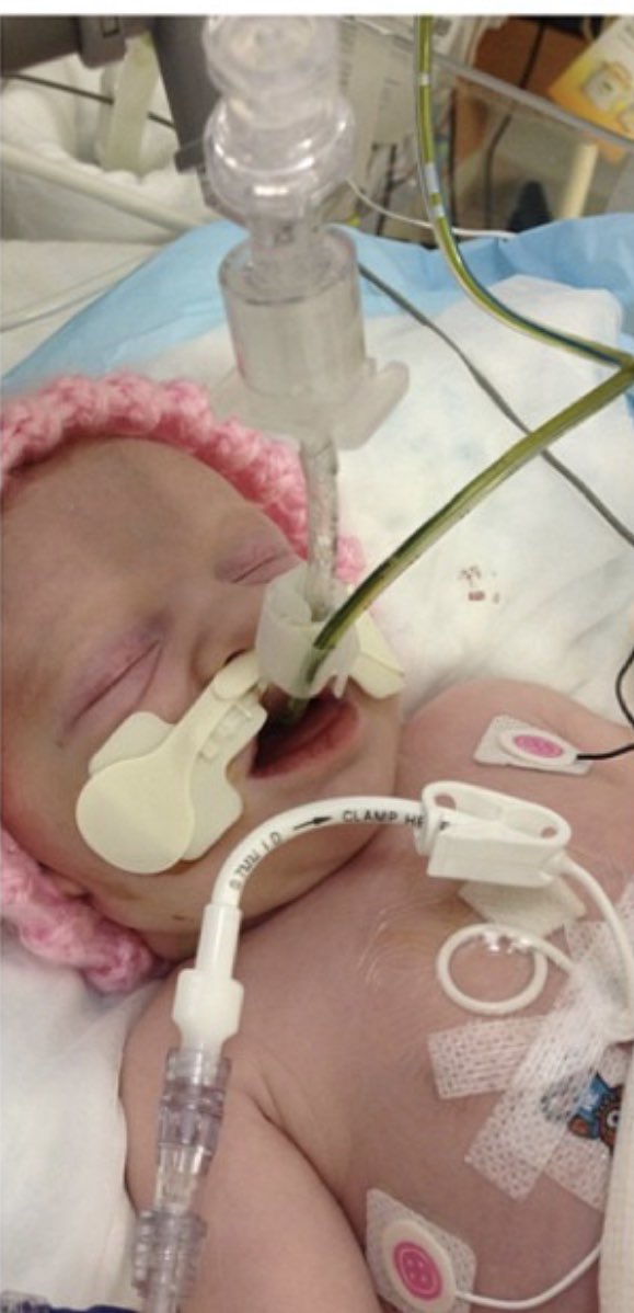 britt_gossett's tweet photo. One of the worst days of my life! They told me when she was only 2 days ok to say goodbye. I took a picture of her holding my hand thinking it was my last. They wheeled her away to surgery and I was broken 🙌🏻 she is alive today and thriving! Educate yourself on birth defects! https://t.co/OAQ32Zyx6q