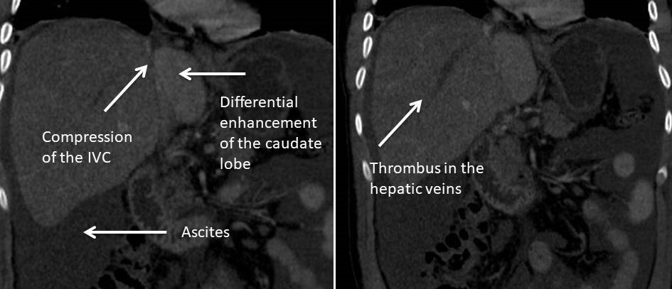Carrying on with the hepatic theme from yesterday, here are a couple of CT images demonstrating acute Budd-Chiari Syndrome. The CT findings can be subtle but the  triad of acute abdominal pain, ascites and hepatomegaly must alter the reporting radiologist.