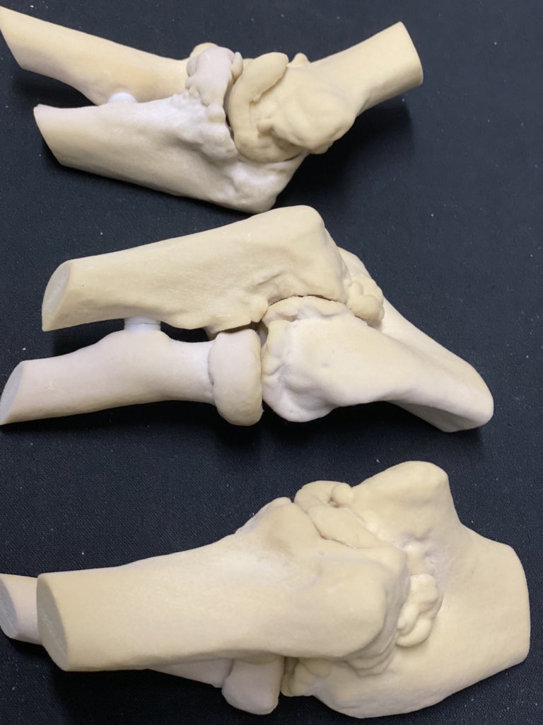 JayMorris_MD's tweet photo. Combine #3Dprinting / @MayoRadiology / #Engineering / passionate #Orthopedics surgeons like #markmorrey = improved patient care . #innovation in Elbow surgery has come though practice of what "may" be possible on #patient models @3dsystems #projet660 paraffin embedded #MEDTECH https://t.co/L9L022k4MY