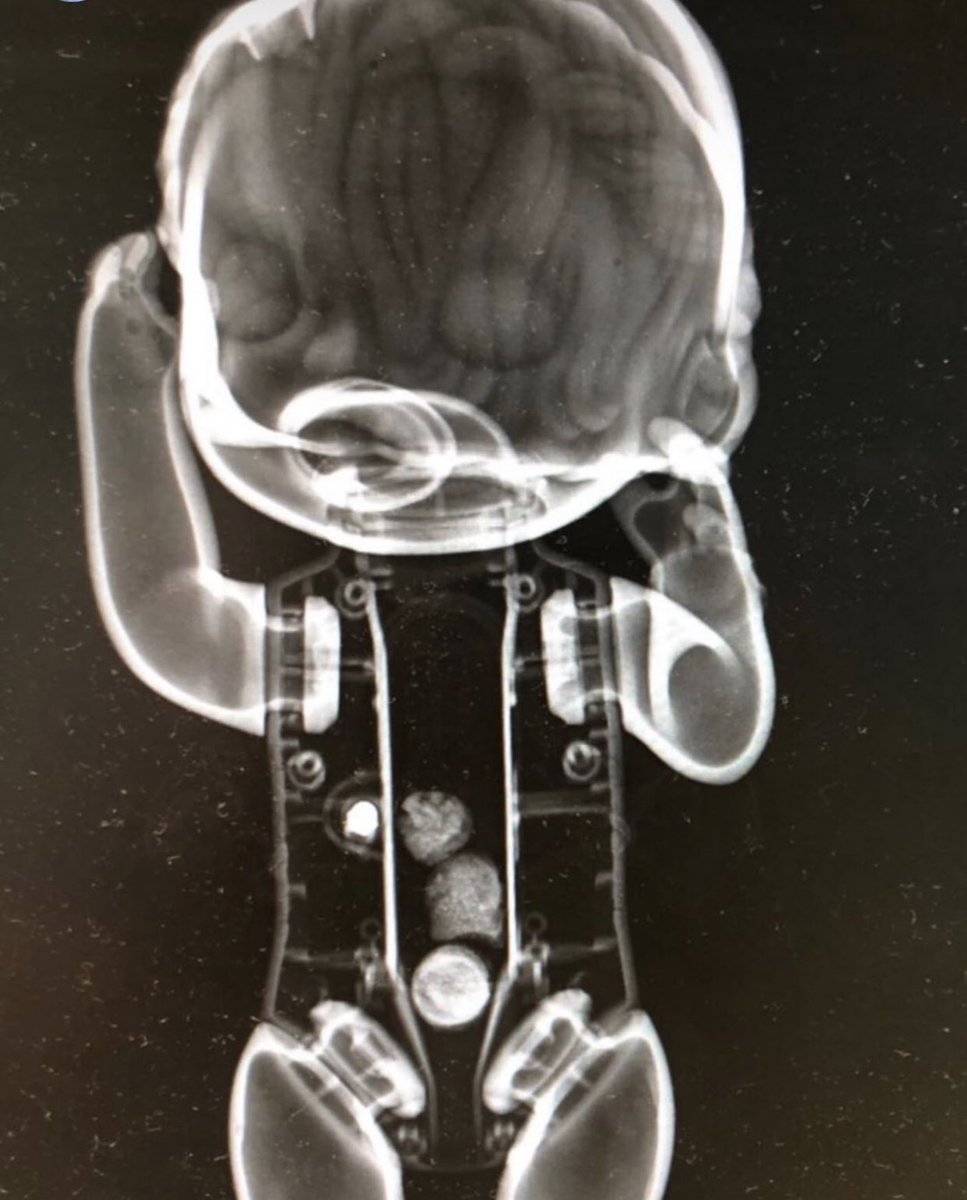 Küçük bir kız çocuğu röntgen çekilmekten korktuğu için önce kızın oyuncak bebeğinin röntgenini çekmişler. ♥️ görüntü başta ürkütücü olsa da hikayeden sonra çok tatlı görünüyor :) sonrasında kızımız tabii ki filmi çektirmiş 🍾