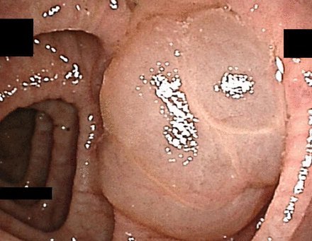Guess what...interesting GI snapshot  <a href="/Gut_BMJ/">Gut Journal</a>