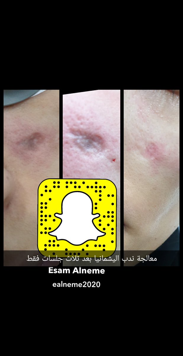 dresam2020's tweet photo. #معالجة_الندب #د_عصام_النمي #مجمع_العالم_الطبي #فيلر_شفايف #أبها #بنات_أبها #خيوط https://t.co/vqCYYjIMa7