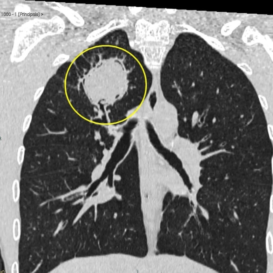 Med_nofake's tweet photo. Signo de Monod o semiluna🌙

Consiste en la presencia de aire alrededor de una masa dentro de una cavidad pulmonar preexistente, generalmente indica la presencia de un micetoma dentro de la cavidad.✍️‼️
#MedNoFake #medtime https://t.co/DdnouNQifK