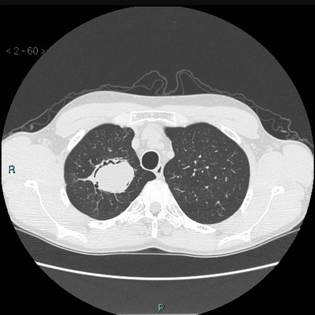 Med_nofake's tweet photo. Signo de Monod o semiluna🌙

Consiste en la presencia de aire alrededor de una masa dentro de una cavidad pulmonar preexistente, generalmente indica la presencia de un micetoma dentro de la cavidad.✍️‼️
#MedNoFake #medtime https://t.co/DdnouNQifK