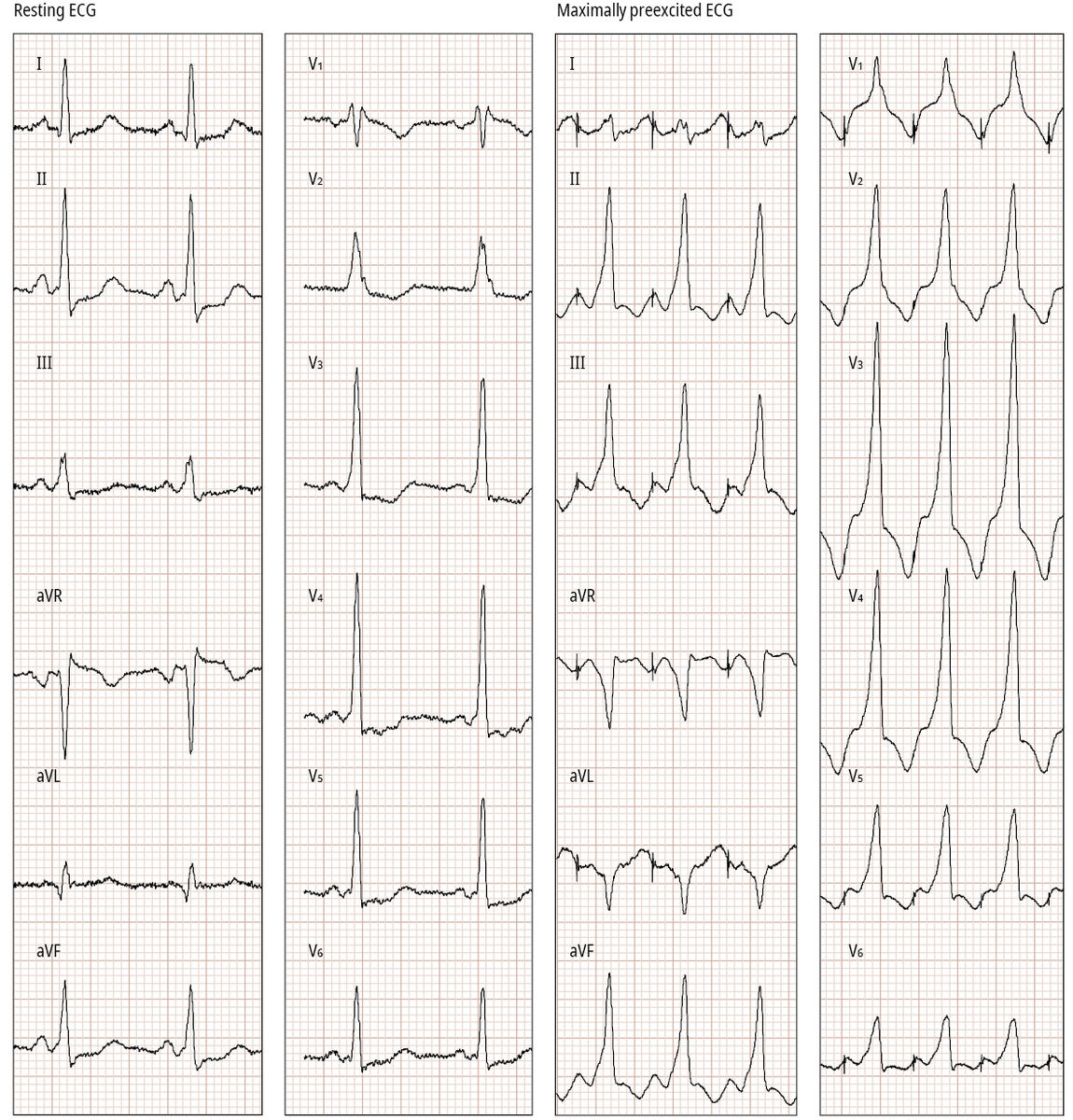 heart_polish's tweet photo. Editors’ Insights: Increased #preexcitation on #ECG improves accuracy of algorithms for accessory pathway localization in Wolff���Parkinson–White #WPW syndrome.
https://t.co/eOcwKAGd05 #KardiologiaPolska #PolishHeartJournal #cardiotwitter @drpmoskal @Marek_Jastrz_EP https://t.co/qNW8uMT9HY