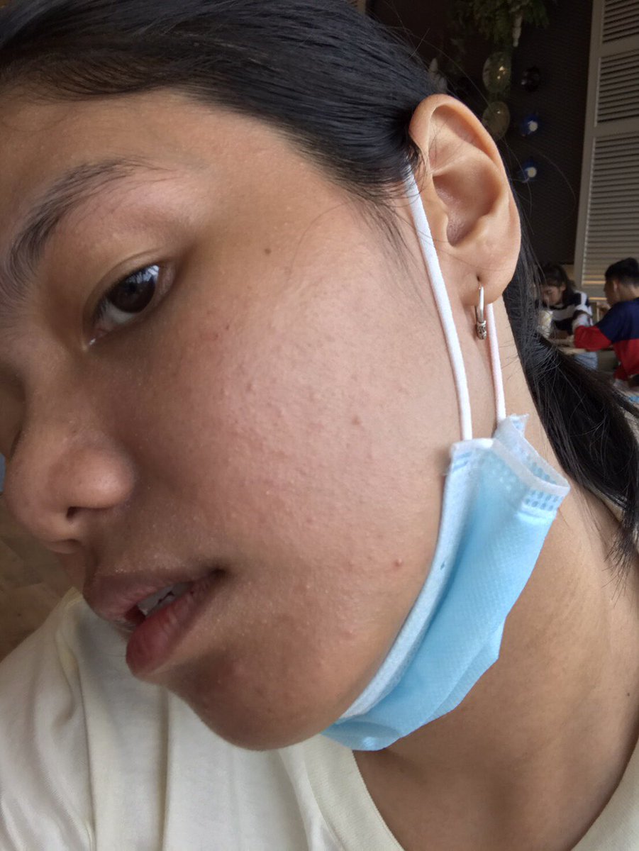 mongkonshop's tweet image. #ใช้ดีบอกต่อ ความมหัศจรรย์ของโทนเนอร์พี่จุนคือเรื่องจริงอ่ะ ความหายนะจากการแพ้น้ำหลังจากไปตะลอนเที่ยวทะเลมา หน้าก็คล้ำ แบบผื่นก็ขึ้น คิดว่าไม่ไหวแล้ว ไม่กล้าใช้ไรเลย ใช้แต่โทนเนอร์พี่จุน แล้วพี่เค้าก็ช่วยชีวิตอีกครั้ง ผื่นเอยไรเอย หายไปหมดเลยอ่ะ(1) #รีวิวสกินแคร์ #โทนเนอร์พี่จุน