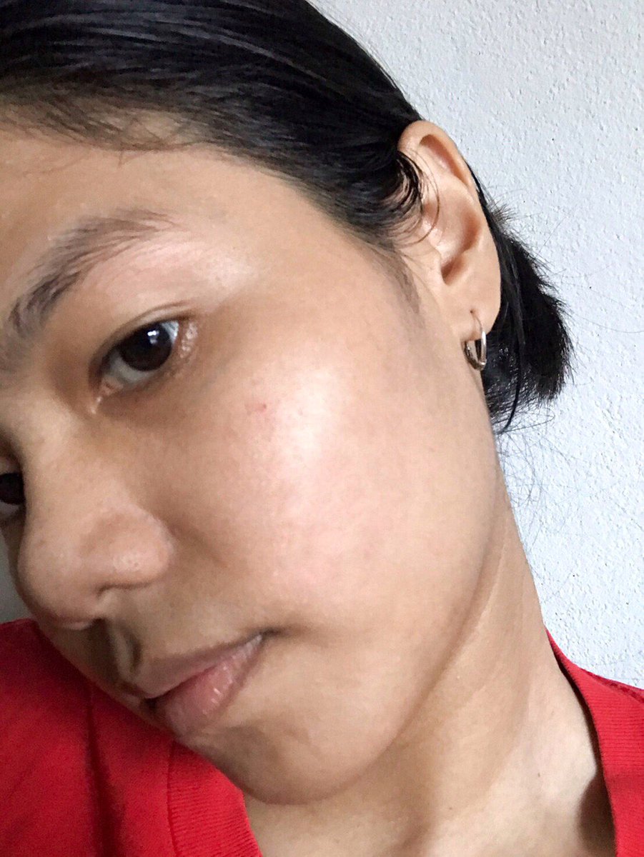 mongkonshop's tweet image. #ใช้ดีบอกต่อ ความมหัศจรรย์ของโทนเนอร์พี่จุนคือเรื่องจริงอ่ะ ความหายนะจากการแพ้น้ำหลังจากไปตะลอนเที่ยวทะเลมา หน้าก็คล้ำ แบบผื่นก็ขึ้น คิดว่าไม่ไหวแล้ว ไม่กล้าใช้ไรเลย ใช้แต่โทนเนอร์พี่จุน แล้วพี่เค้าก็ช่วยชีวิตอีกครั้ง ผื่นเอยไรเอย หายไปหมดเลยอ่ะ(1) #รีวิวสกินแคร์ #โทนเนอร์พี่จุน