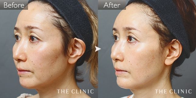 The Clinic ザクリニック エイジング治療 おでこの脂肪注入 症例写真をご紹介 へこみ気味なおでこや平坦なおでこ も きれいな丸いラインにすることが可能です あなたもおでこ美人になりませんか 現在 おでこの脂肪注入 モニターを募集中です