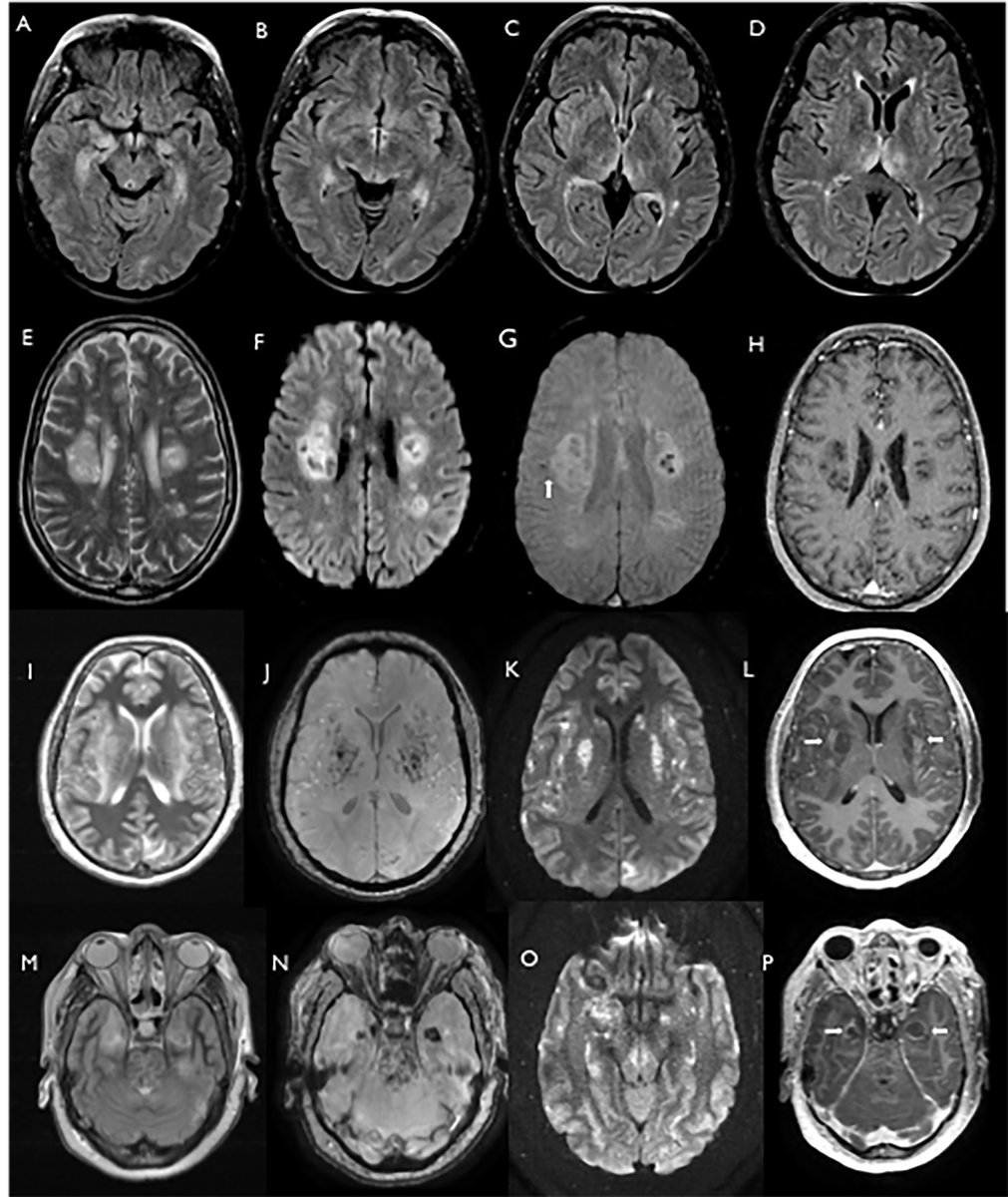 Paterson, Brown et al. present clinical, radiological and laboratory findings from patients with neurological complications of SARS-CoV-2 infection. bit.ly/2BRZEIP #COVID @michael_zandi