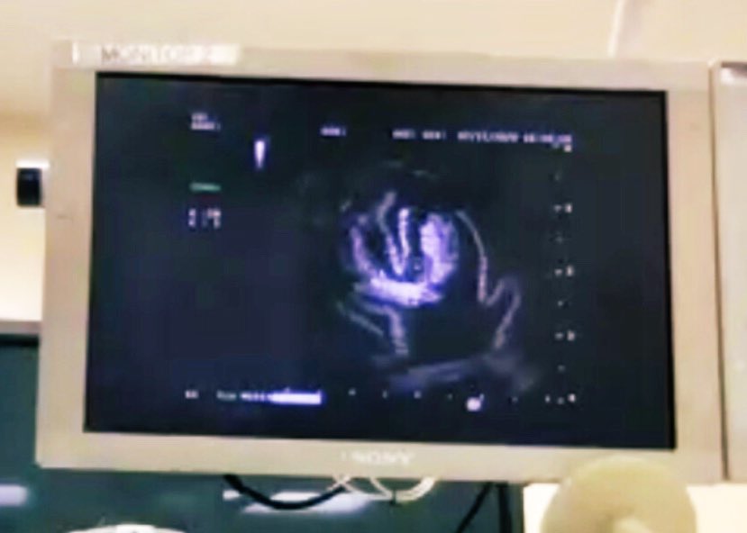 sfaiz212's tweet photo. Live from @UTHSA_PCCM #Bronchoscopy suite Dr Phil Ong teaching virtual #SWRegBootCamp the #IP π #EMN #EBUS Note radial probe image in π§ π¦ Im not used to seeing Dr Ong without Dr Debiane @DebianeLabib @HFHPulmCC Both #MDAPulmonary @GAEapenMD https://t.co/2FhTebUs5t