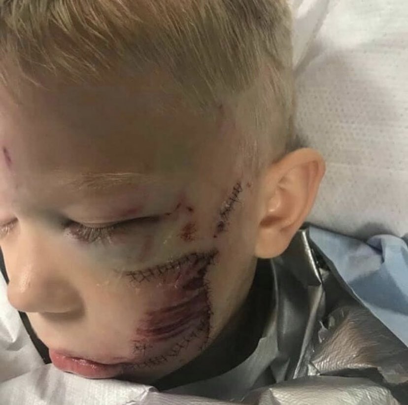 FotosDeFatos's tweet photo. Herói: o pequeno Bridger Walker, 6 anos, levou cerca de 90 pontos no rosto ao saltar na frente de um cão raivoso para salvar a irmã, 14 de julho de 2020. ©Nicole Walker https://t.co/yeRgXaBkGr