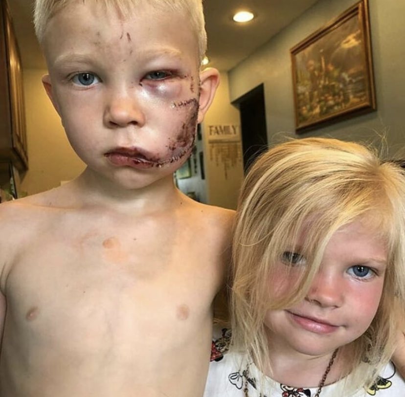 FotosDeFatos's tweet photo. Herói: o pequeno Bridger Walker, 6 anos, levou cerca de 90 pontos no rosto ao saltar na frente de um cão raivoso para salvar a irmã, 14 de julho de 2020. ©Nicole Walker https://t.co/yeRgXaBkGr