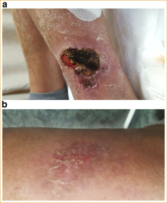 ARTICLE IN PRESS
Letter to the Editor: Clinical characteristics and outcomes of patient with calciphylaxis
M. Zakher, et al.

amjmedsci.org/article/S0002-…